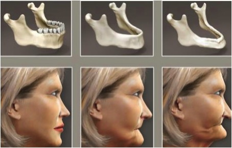 Csont felszívódás