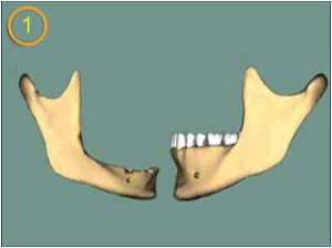 Csont felszívódás